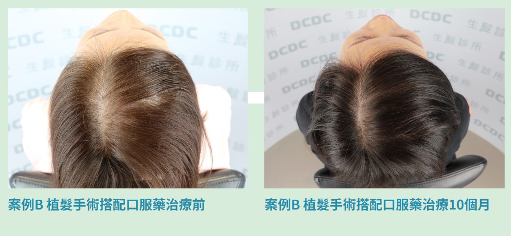 植髮手術搭配口服藥治療案例