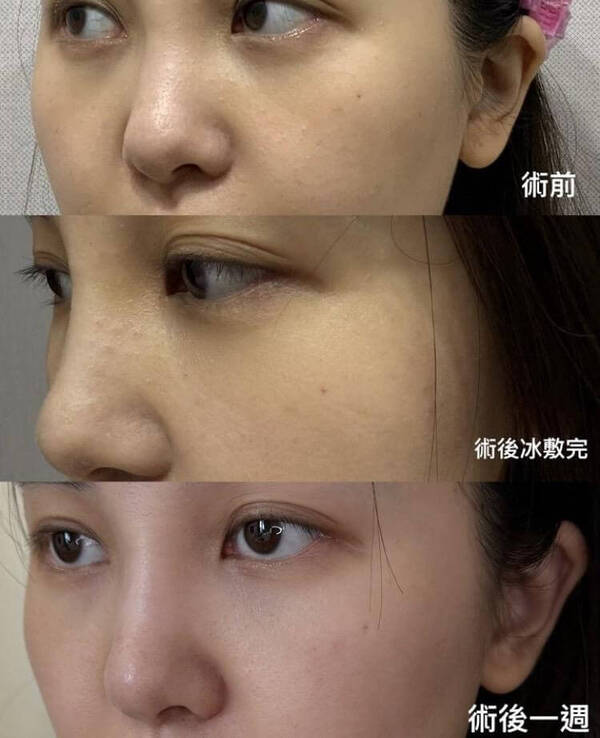 水光槍案例分享