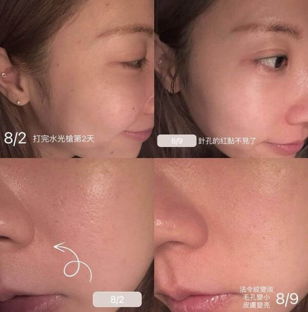 水光槍案例分享