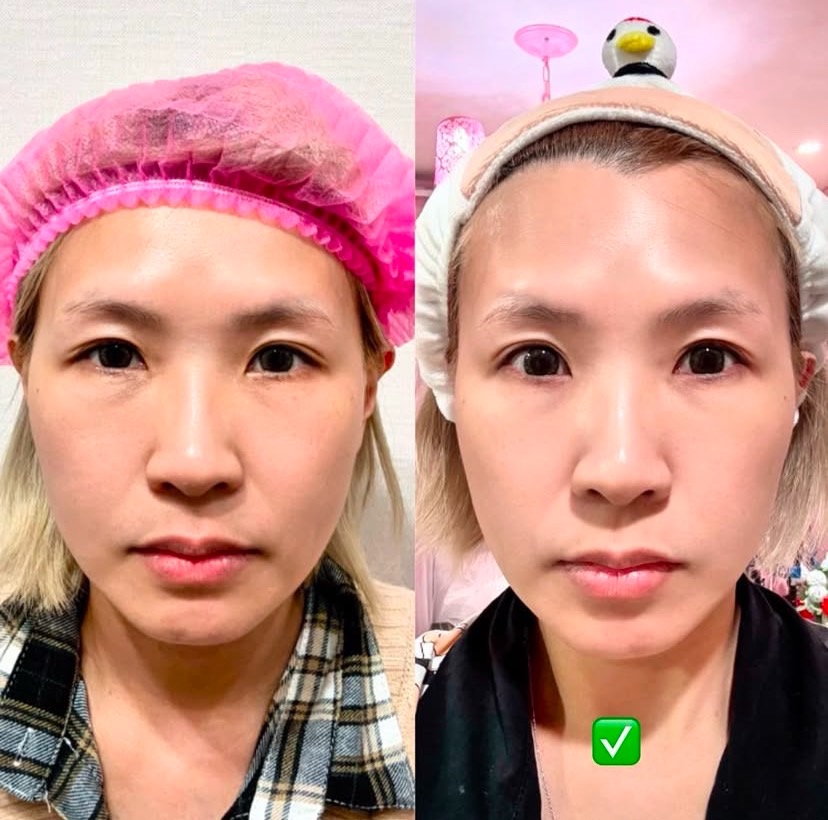玩美電波法令紋消除案例分享