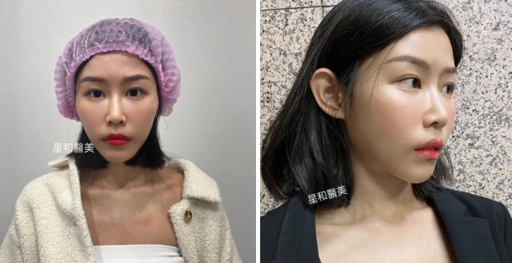以玻尿酸注射療程填補臉部凹陷，重拾膨彈青春的容顏