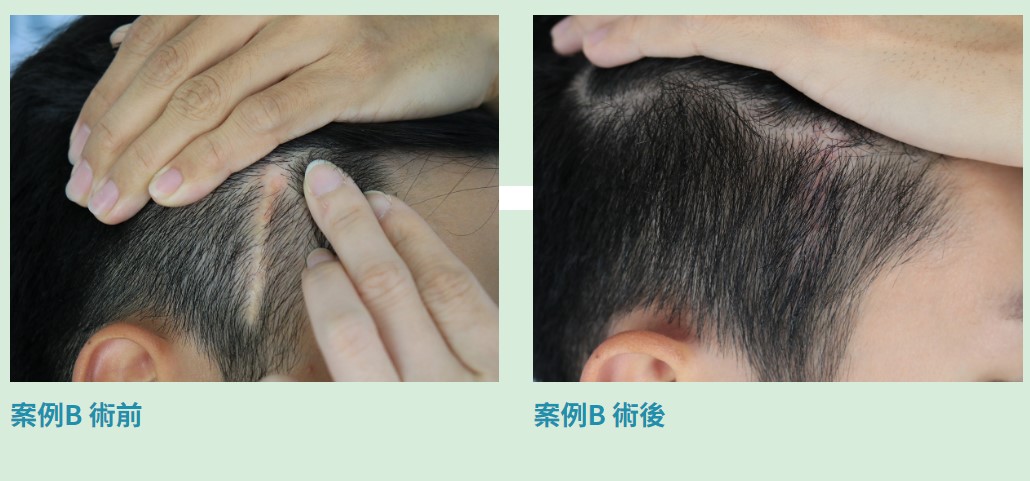 DCDC疤痕手術後，明顯蓋住痕跡超有感