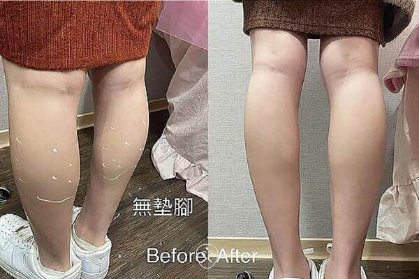 肉毒瘦小腿案例