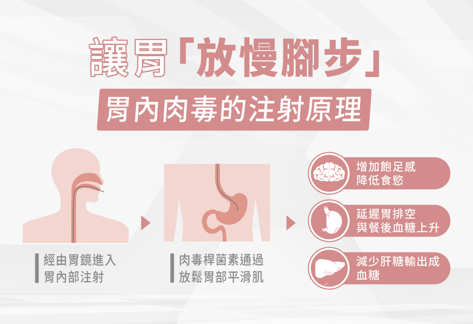 胃內肉毒減重的方式