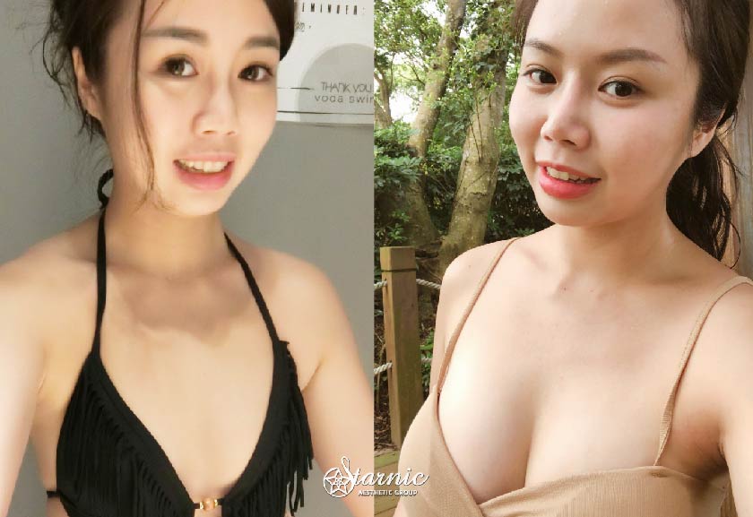 【果凍隆乳+大腿抽脂】星采整形外科診所(大安醫美)-邱大睿醫師-25歲以後也來的及擁有夢幻的身材-HONEY