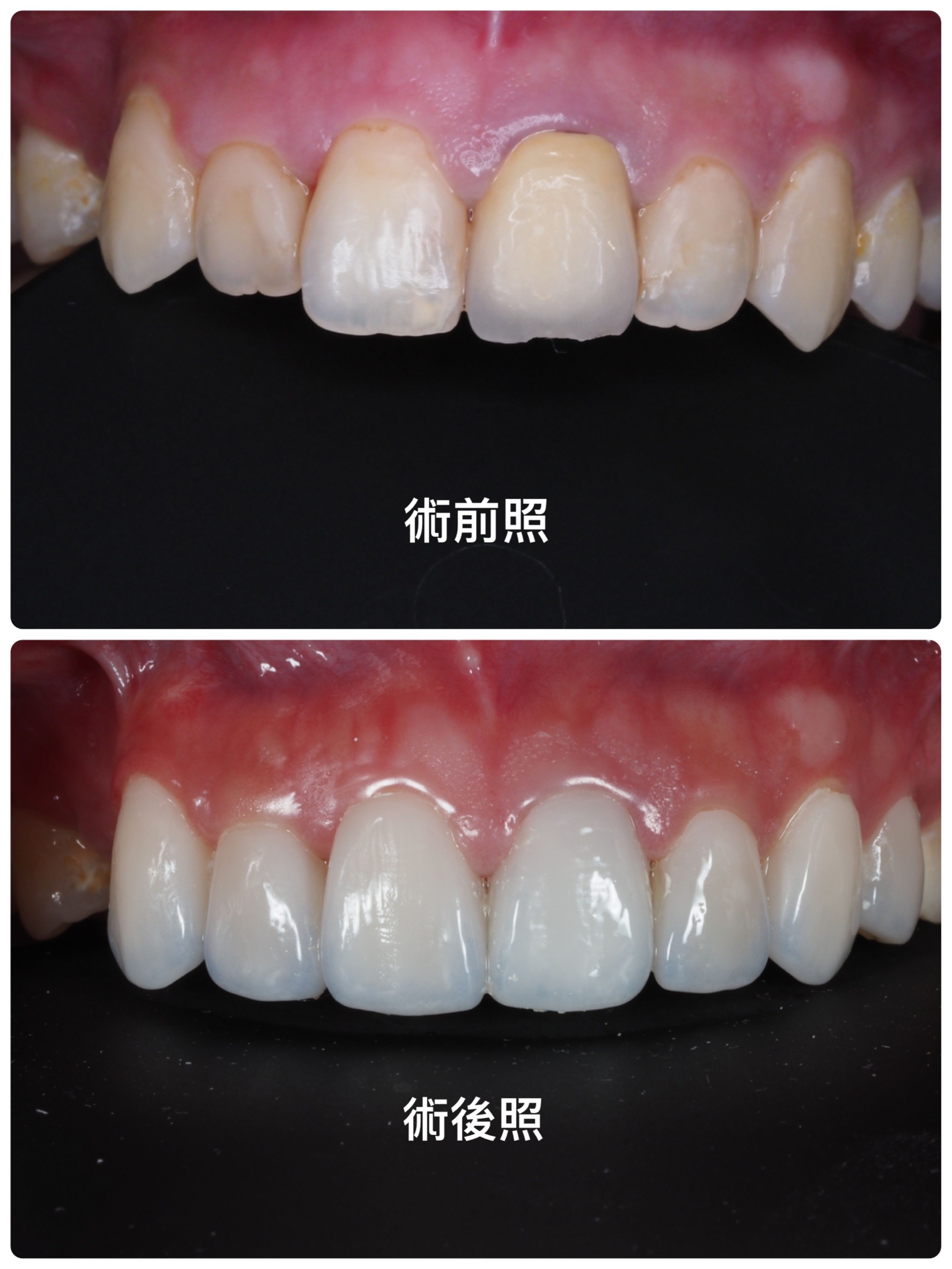 陶瓷貼片案例