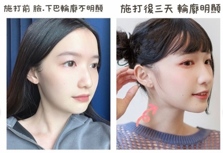 韓國Q+立線音波效果超顯著