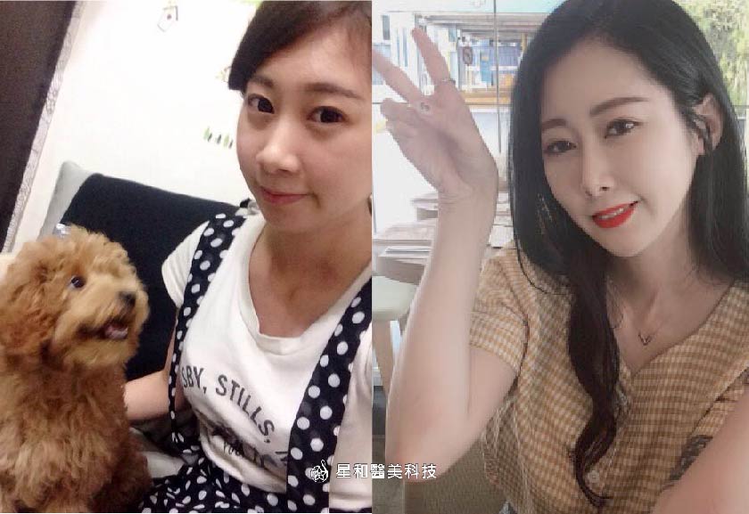 玻尿酸 星采整形外科診所 大安 武洵白醫師 還我青春顏值 消滅從小就跟著我一起長大的貓咪紋 上 小檸 萬人好評