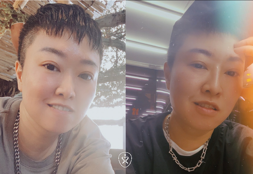 玻尿酸隆鼻 星和診所 台中醫美 陳毅修醫師 山根挺起來 就像換了張臉 寶豬 萬人好評