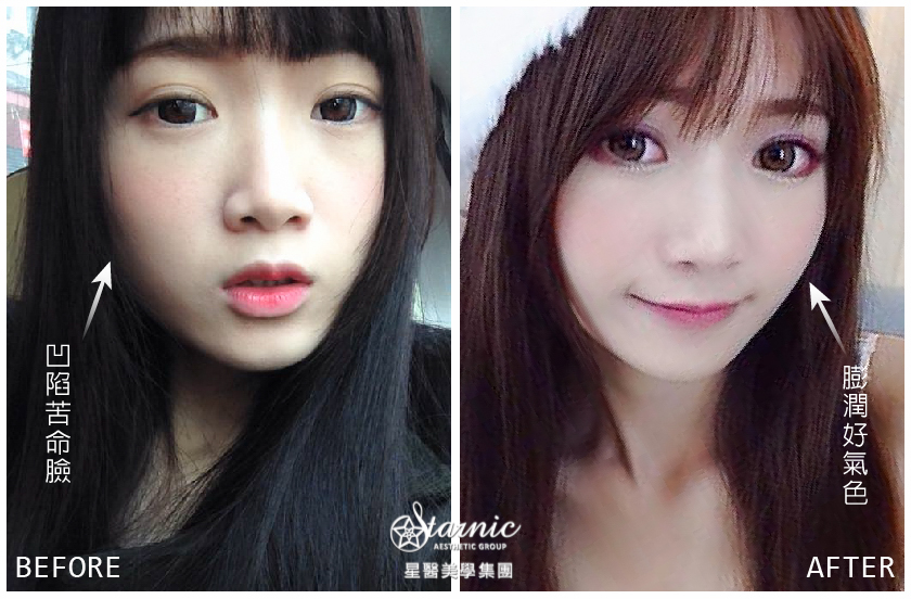 【公主玻尿酸補蘋果肌】星和桃園／張琦瑋醫師-澎澎臉 娃娃系女孩的誕生¬¬_崔甜天