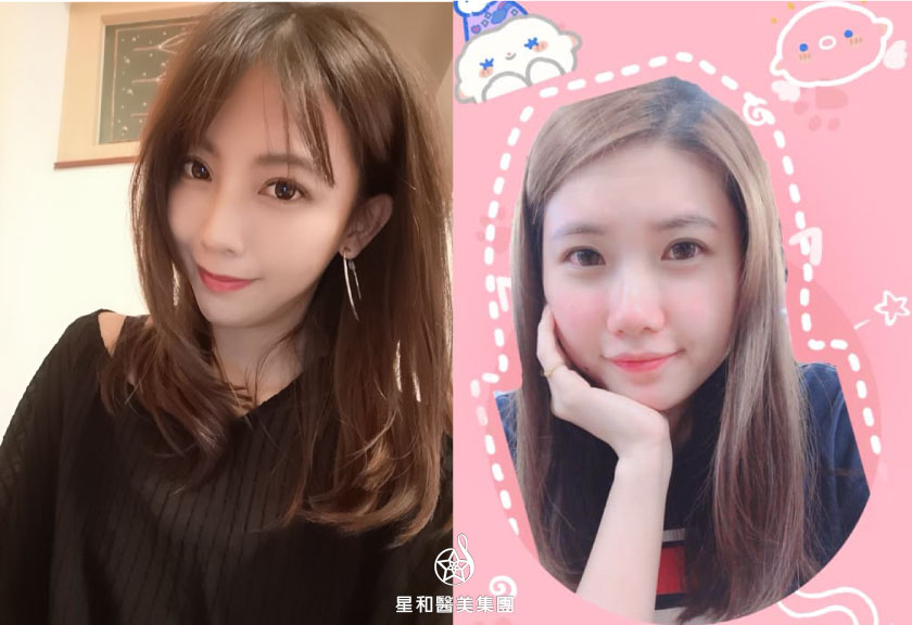 【杏仁酸煥膚】星和診所/台南醫美-不管臉部還是背部，肌膚都要漂亮Q彈！-林瑄、陳曉雅