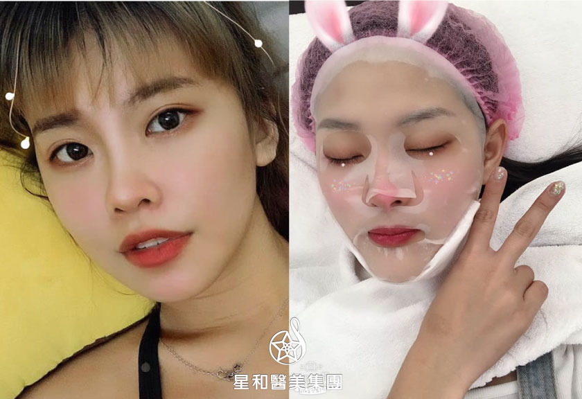 【杏仁酸煥膚】星和診所/台南醫美-告別粉刺，慢走不送!- 施奕安、林苡諾