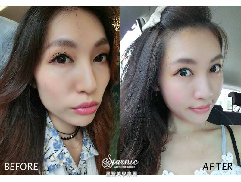 【自體脂肪臉部補脂】星和診所/高雄醫美-不要再當苦命黃臉婆，變身澎澎臉韓系少女！