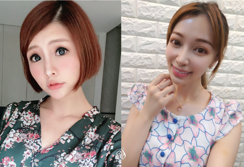 【玻尿酸】