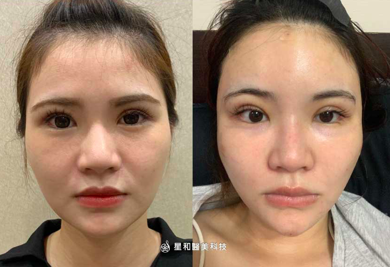 自體脂肪豐額
