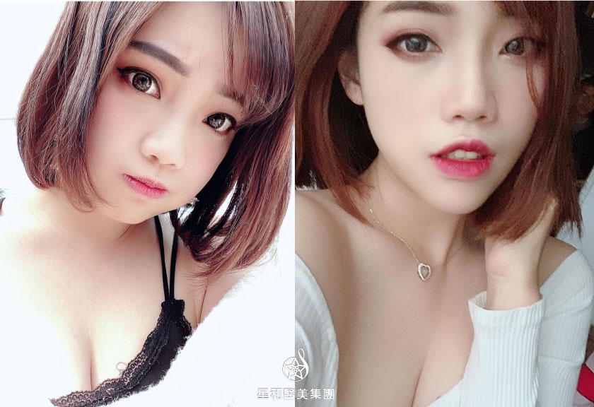 【玻尿酸下巴】星和診所（新竹市）-林明潔醫師-讓我不必再喬角度拍照的自然下巴(上)-葆葆女王
