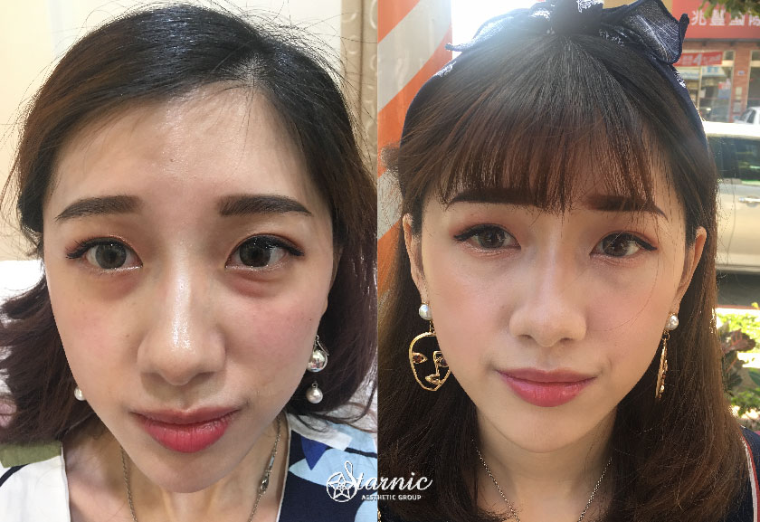 【洢蓮絲Ellanse淚溝】星和診所（新竹市）-薛博今醫師-累累女大轉變．恢復好精神(上)-邯邯
