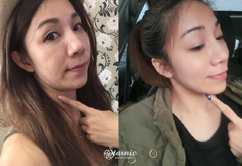 極線音波拉提