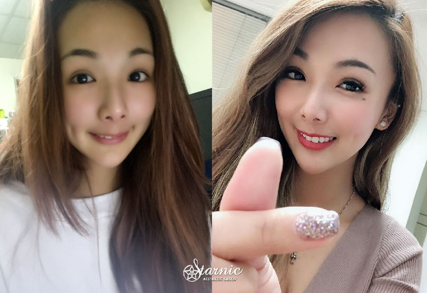 定點雙眼皮