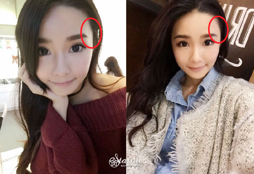 玻尿酸填補夫妻宮