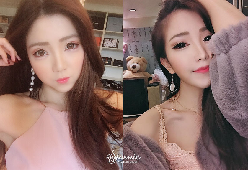 微整形注射
