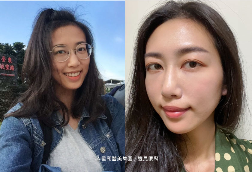 Smile全飛秒近視雷射 星和醫美集團 遠見眼科 張聰麒醫師 還我明亮大眼 短時間讓我重回熱愛的潛水運動 美麗見證