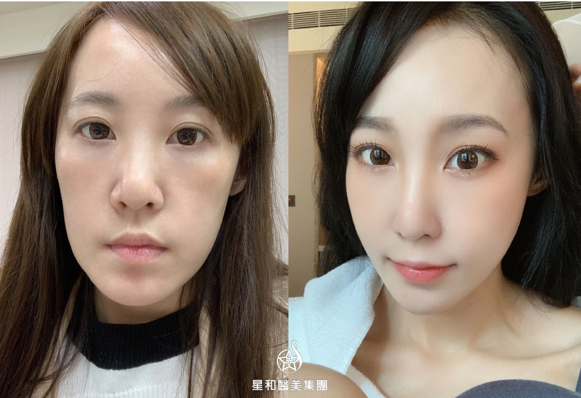 【唇部微笑線/自體脂肪補脂】