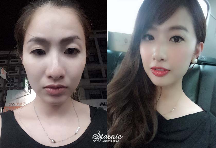 玻尿酸