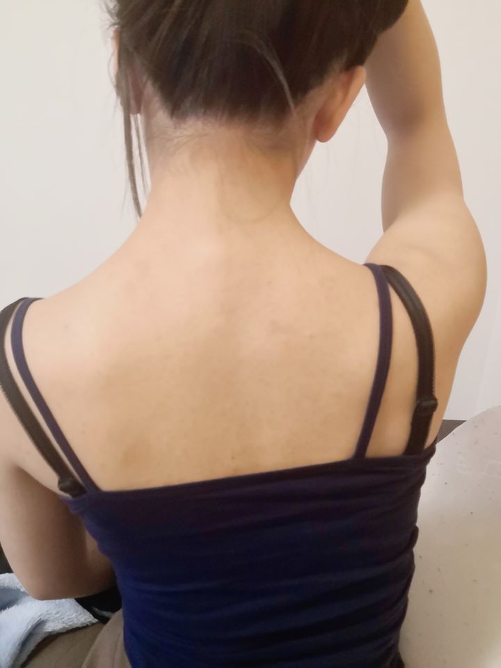 【杏仁酸煥膚】星和診所/台南醫美-不管臉部還是背部，肌膚都要漂亮Q彈！-林瑄、陳曉雅(上)