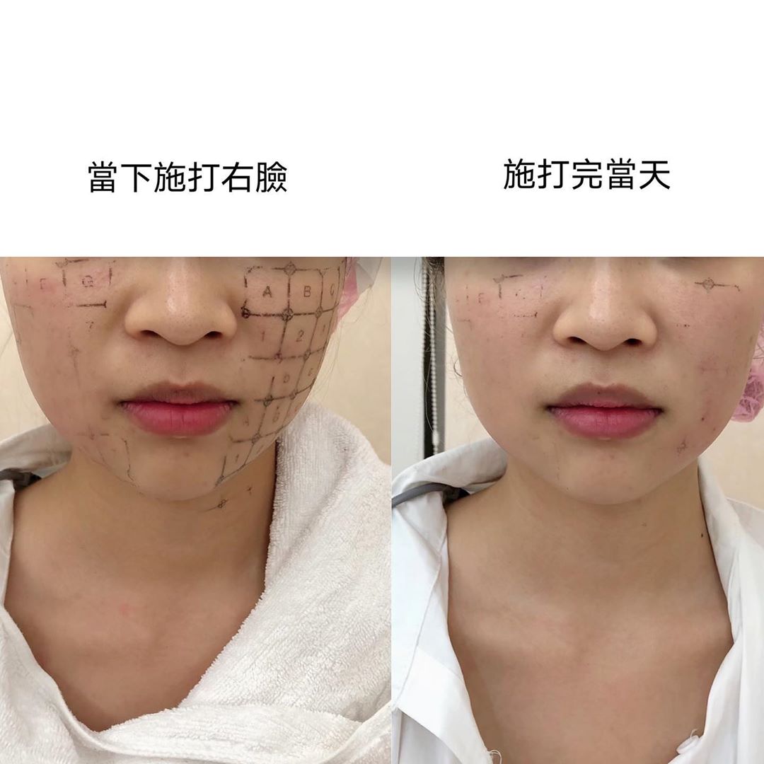 【電波拉提】星和診所（新竹市）、星和診所/台南醫美-嘴邊肉退散-陳俞婷、Megan(下)