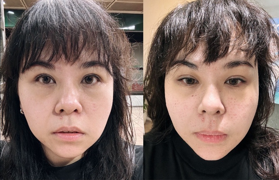 【修秘水光電波】板橋星和診所-黃千乘醫師-效果超明顯的！-曼蒂