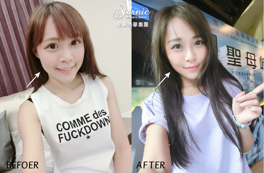 【肉毒瘦小臉&抬頭紋】星采大安-免修圖也能擁有完美的側臉線條+皺眉BEY –小米