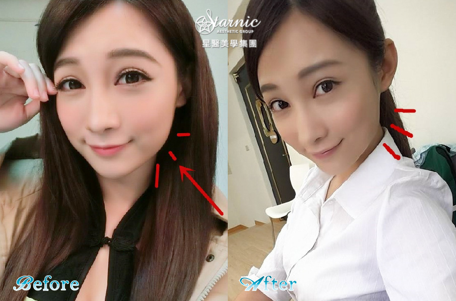 【瘦小臉注射】仁愛星和診所/東區醫美-肉肉臉快消失說BYE BYE＿江若寧 (上)