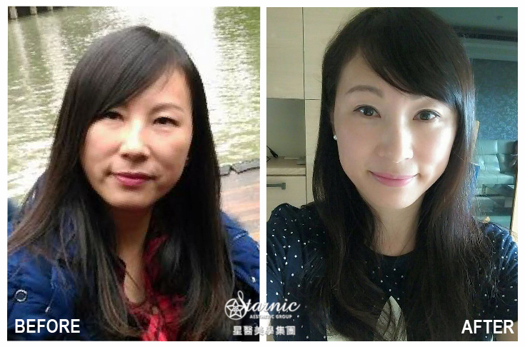 【Ellnase洢蓮絲蘋果肌】星和診所（新竹）薛博今醫師-我不是媽媽之重返童顏少女姐接~