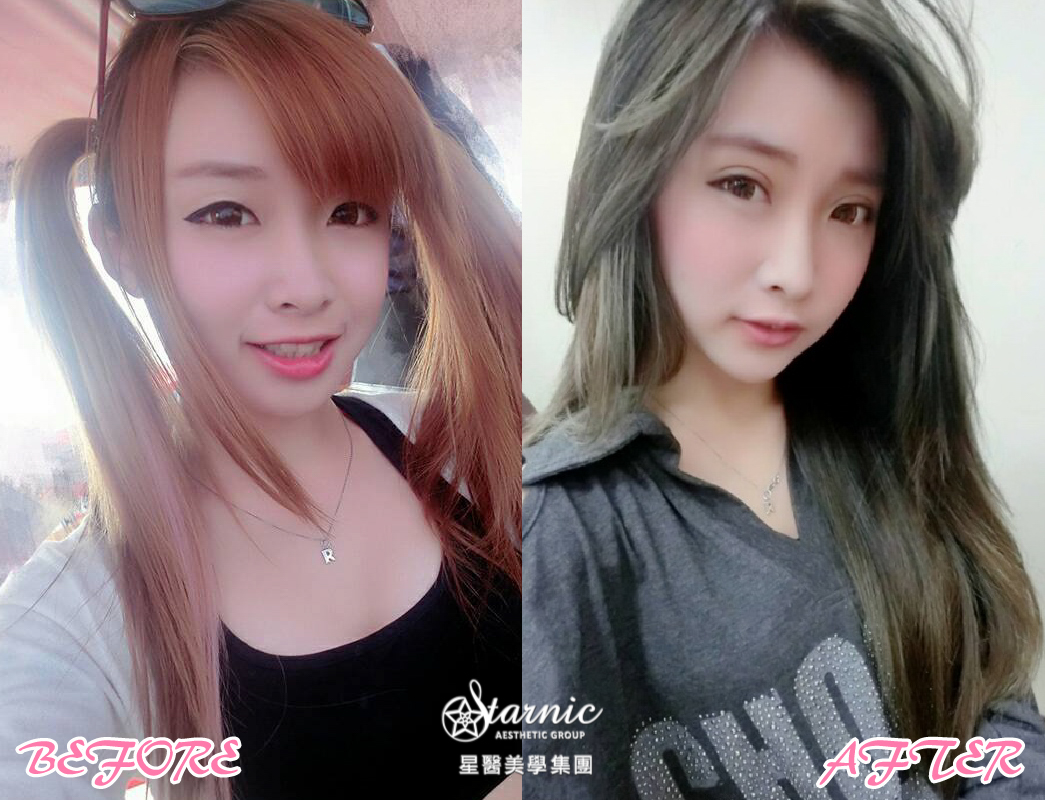 【公主玻尿酸】星采古亭/徐登志醫師-不要再說我臉很大了！有了下巴立刻變小臉-Rebeca小花