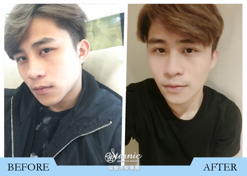 【肉毒瘦小臉】星和台中醫美/于翔宇醫師_臉型關鍵！馬來西亞小王子也追求的小V臉_Sam