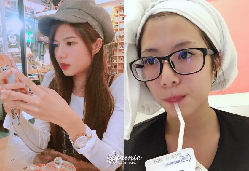 【瘦小臉注射】星和診所/台南醫美-鄭玉貞醫師—我的瘦小臉初體驗—方唯貞Chubby (中)