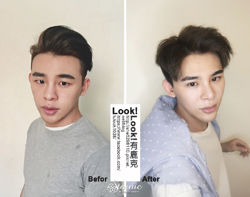 【割雙眼皮+Goretex三段式鼻雕+敲鼻骨】星采整形外科診所(大安)-為了變帥，打掉重練我願意！！-LOOK鹿克