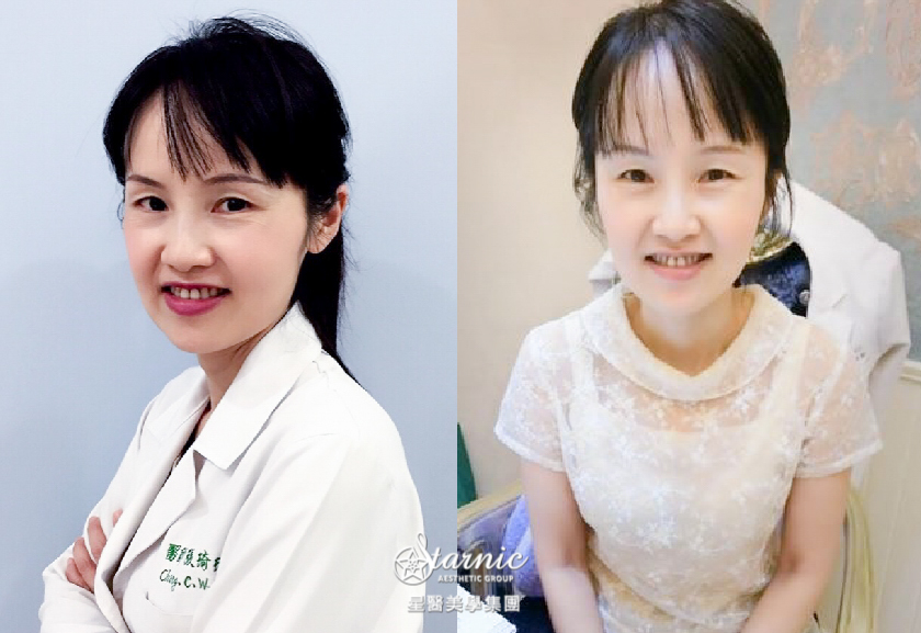 【極線音波拉提】桃園醫美星和診所—連醫美醫師都熱愛~這絕對不是自肥！謝謝同事讓我變年輕啦！