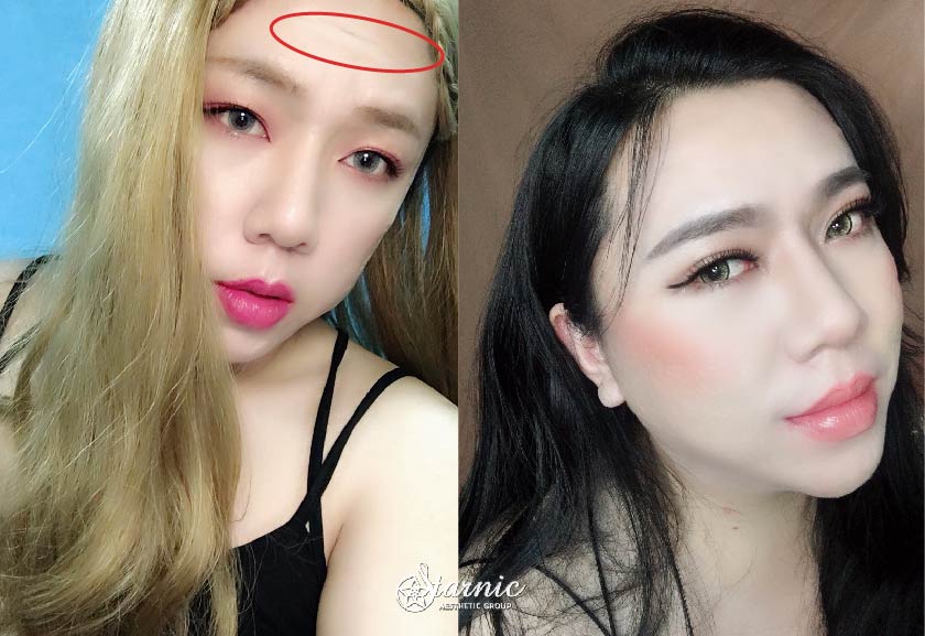 【微整除皺+玻尿酸填補抬頭紋】星和診所/台南醫美-鄭玉貞醫師-還我平滑肌，臉上鴻溝都Out！-金枝 (下)