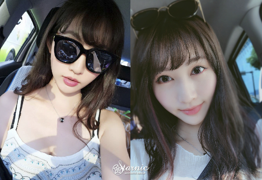 【瘦小臉注射】 星和診所/高雄醫美-杜絕強大咀嚼肌就靠肉毒達成!_張晏綾 (上)