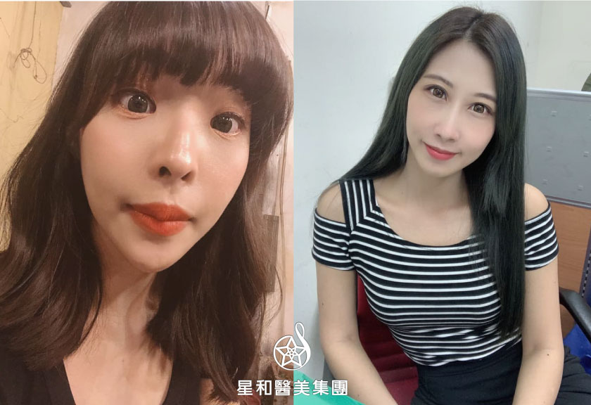 【杏仁酸煥膚】星和診所/台南醫美-說煥就煥，我說了算-劉言言、Vivi Wu