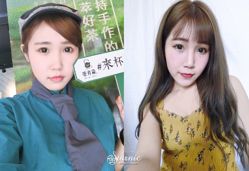 【肉毒瘦小臉】星和診所（新竹市）薛博今醫師-肉毒讓臉的比例看起來拉長好多小好多！-曾鈺婷