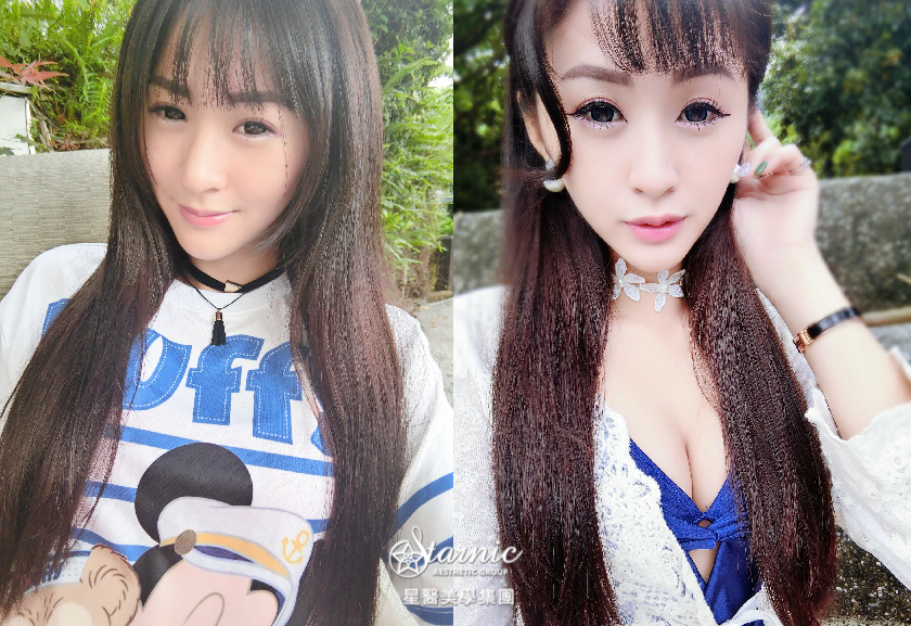 【水微晶補下巴】星和高雄醫美/鄭玉貞醫師-兩個屁股掰掰~擁有V型臉再也不是夢想囉！_蘿菈