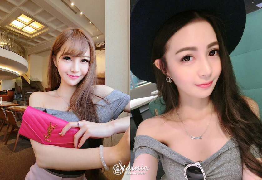 【Ellanse洢蓮絲】星和診所/高雄醫美-飽滿蘋果肌、告別黑眼圈，讓我偷偷變回18歲(上)-詹君臻