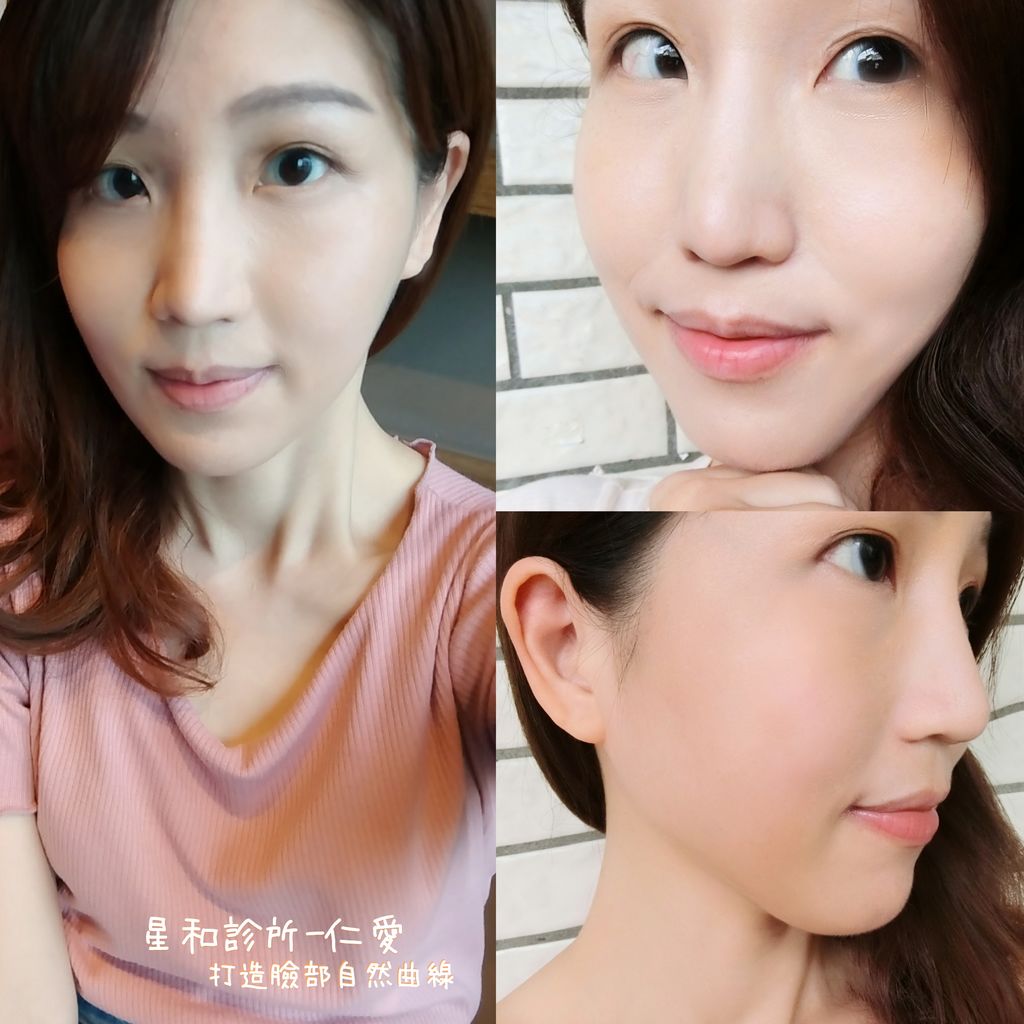 【玻尿酸隆鼻+肉毒小臉】