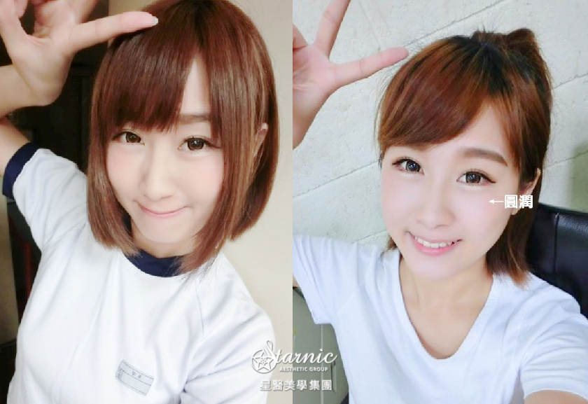 【玻尿酸蘋果肌】
