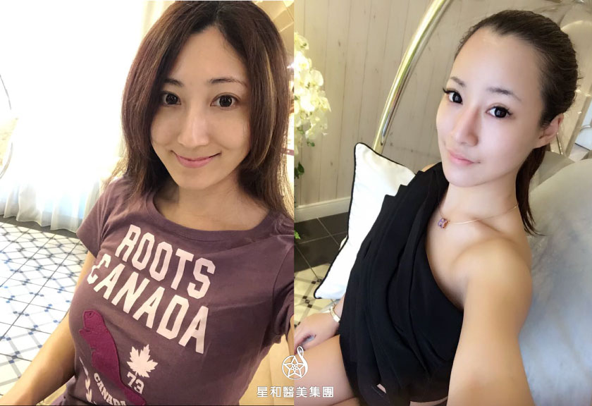 【杏仁酸煥膚】星采皮膚專科診所(古亭)-還我美麗又漂亮的肌膚-孫咪咪、Yui Huang