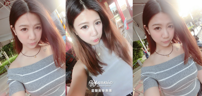 【肉毒桿菌抬頭紋】星和診所(桃園)游家文醫師-還我年輕光亮額頭～
