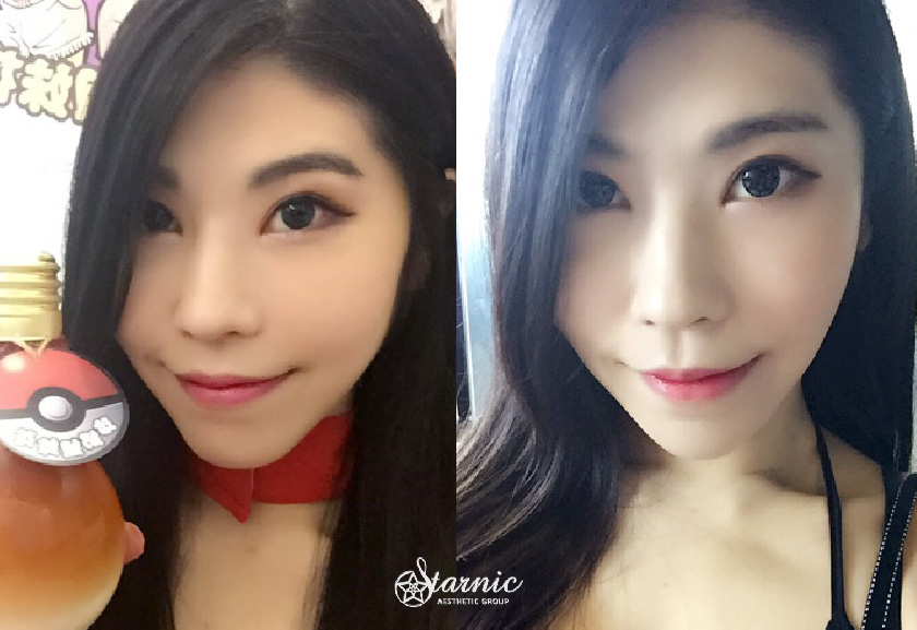 【肉毒瘦小臉+肉毒抬頭紋】星采整形外科診所(大安)/林君曄醫師-咀嚼肌抬頭紋一次掰掰！我真的太愛肉毒桿菌了-丁法法